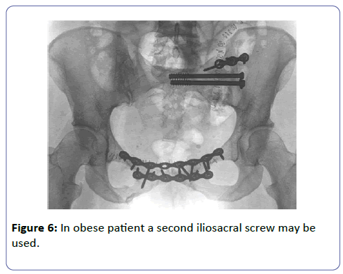 clinical-experimental-iliosacral-screw