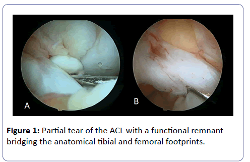 clinical-experimental-orthopedics-Partial-tear