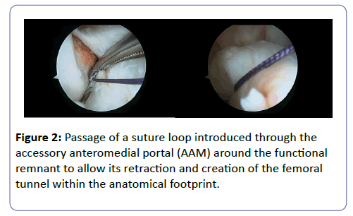 clinical-experimental-orthopedics-Passage-suture