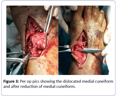 clinical-experimental-orthopedics-dislocated-medial