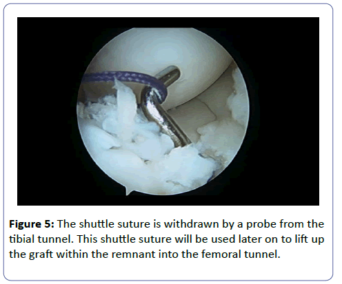 clinical-experimental-orthopedics-femoral-tunnel