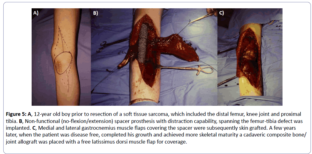 clinical-experimental-orthopedics-latissimus-dorsi