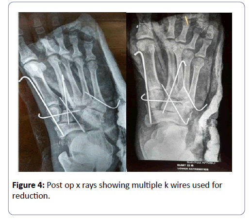 clinical-experimental-orthopedics-multiple-wires
