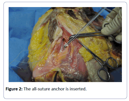 clinical-experimental-orthopedics-suture-anchor