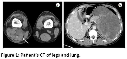 orthopedics-CT-legs-lung