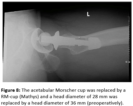 orthopedics-Morscher-cup-replaced