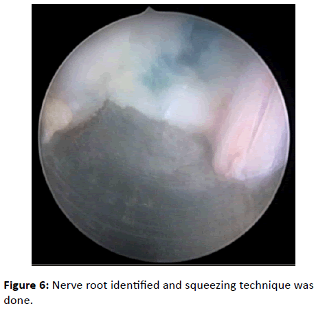 orthopedics-Nerve-root