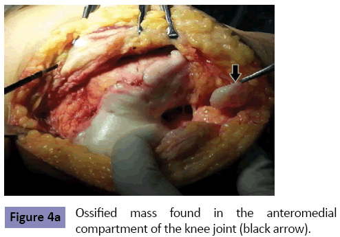 orthopedics-Ossified-mass-found