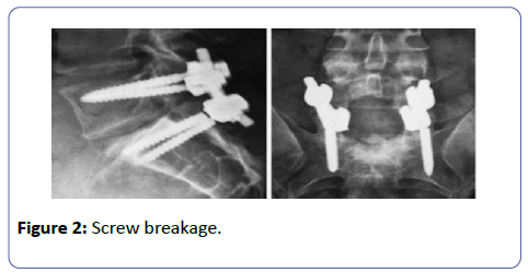 orthopedics-Screw-breakage