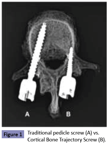 orthopedics-Traditional-pedicle-screw