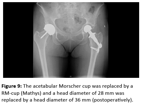 orthopedics-acetabular-Morscher-cup-replaced