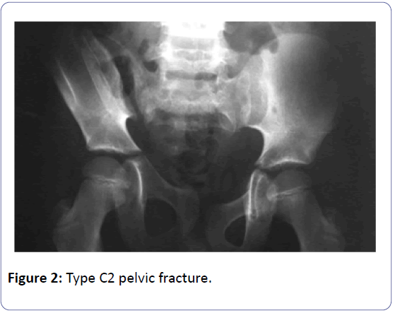 orthopedics-c2-pelvic-fracture
