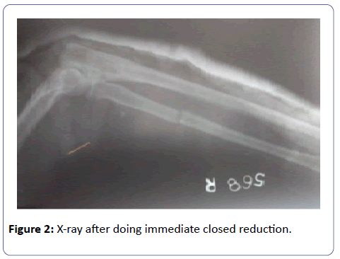 orthopedics-closed-reduction