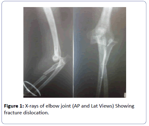 orthopedics-elbow-joint