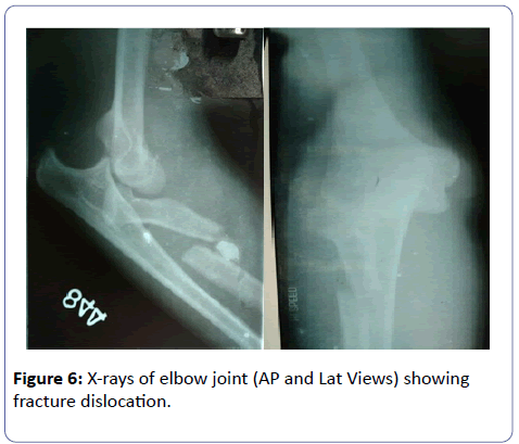 orthopedics-fracture-dislocation