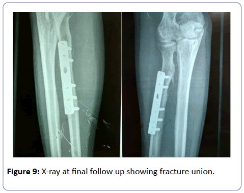 orthopedics-fracture-union
