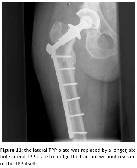 orthopedics-lateral-TPP-plate