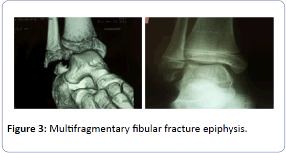 orthopedics-multifragmentary-fibular