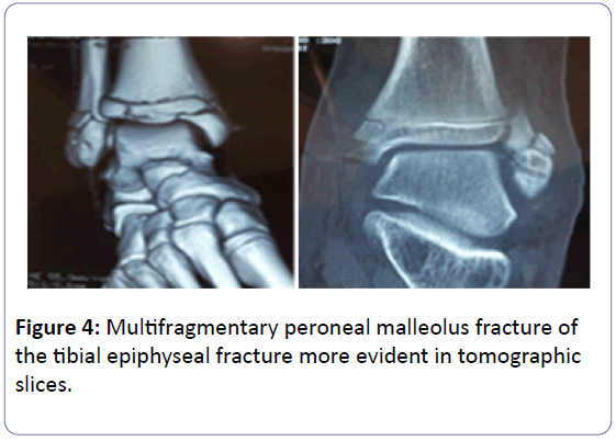 orthopedics-peroneal-malleolus-fracture