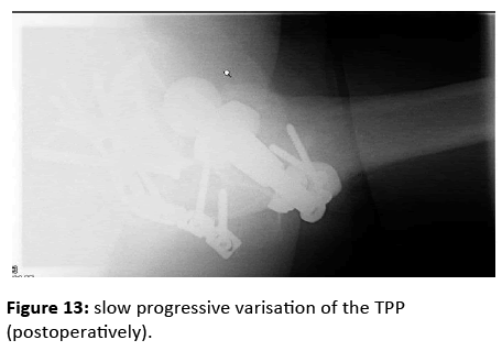 orthopedics-progressive-varisation-TPP