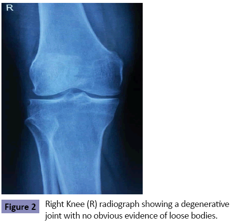 orthopedics-radiograph-showing-degenerative