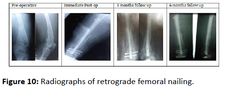 orthopedics-retrograde