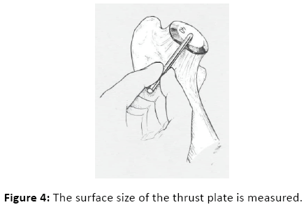 orthopedics-surface-size-thrust-plate